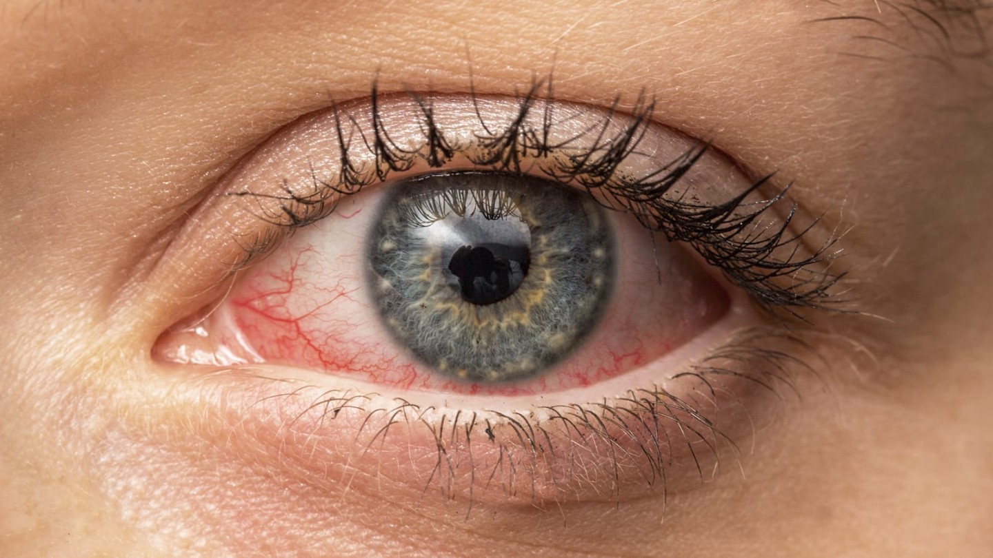 Dry eye syndrome